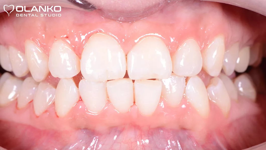 Відбілювання зубів Бровари Київ системою Magic Light (після)