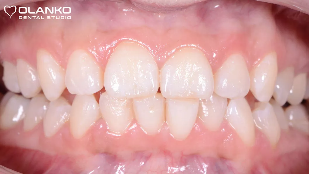 Відбілювання зубів Бровари Київ MagicLight (до)