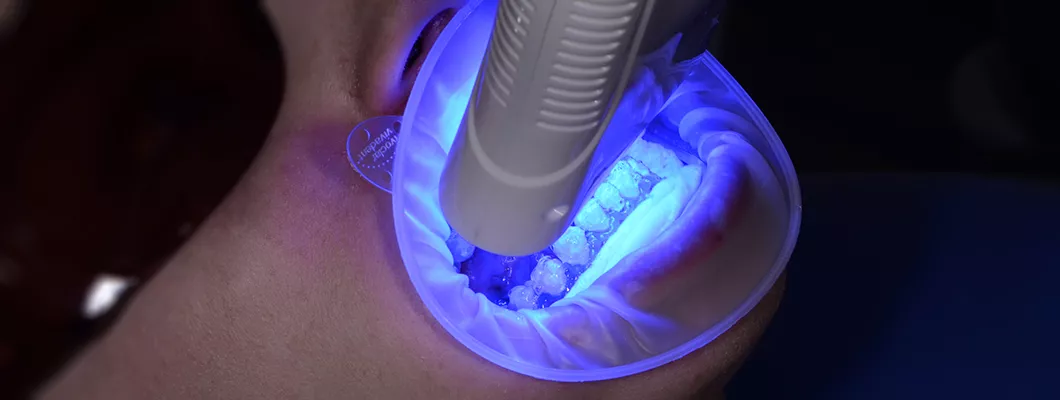 Відбілювання зубів Бровари Київ Magic Smile Magic Light Pro