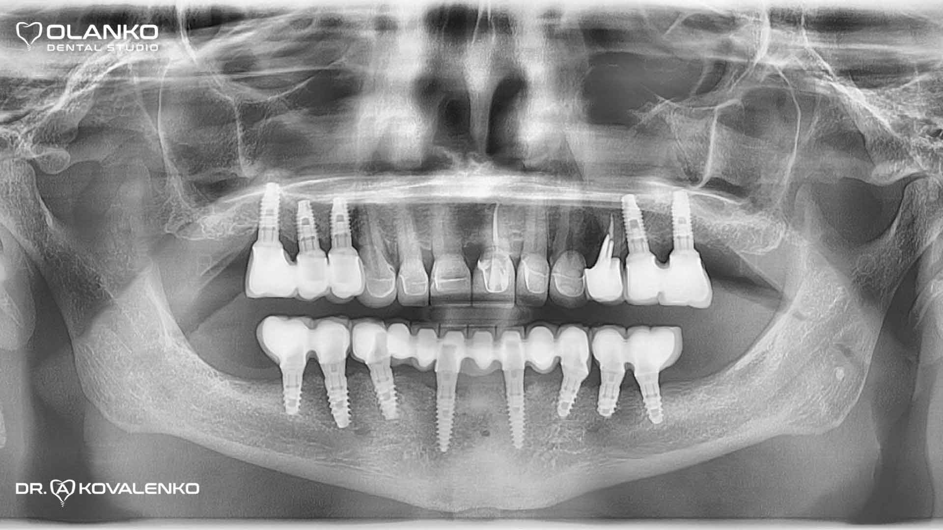 Контрольний панорамний рентген знімок через 8 років після протезування, стабільний рівень кістки навколо зубних імплантатів
