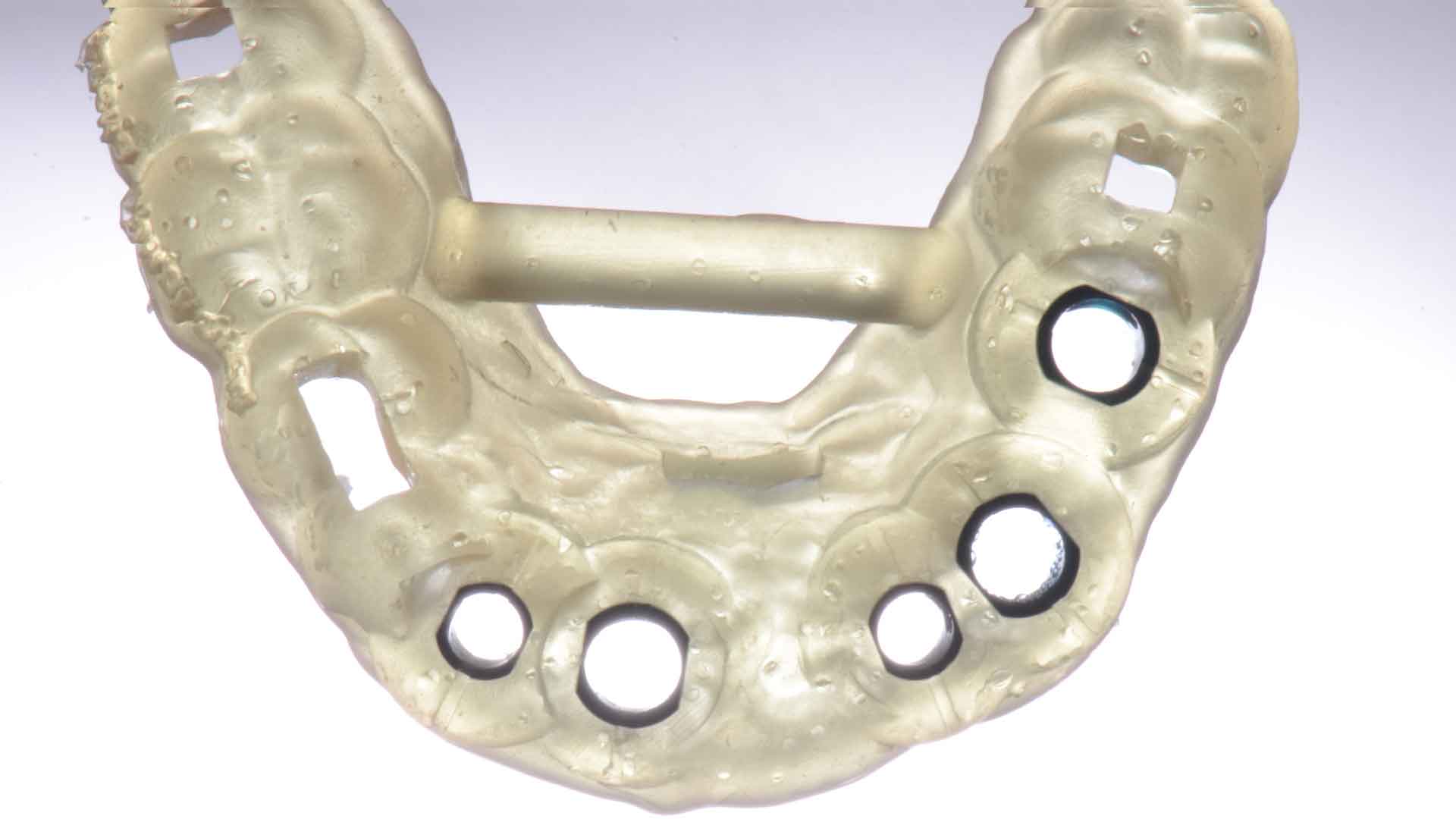Фото хірургічного шаблону для одномоментної установки 5-ти зубних імплантатів