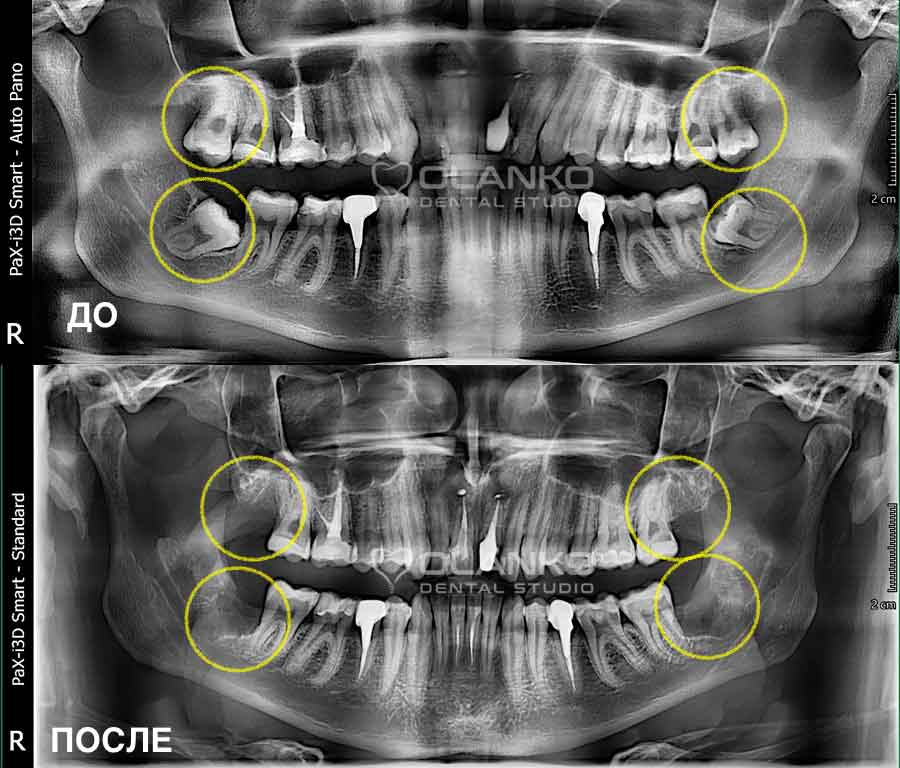 Фото панорамний знімок зубів ДО і ПІСЛЯ видалення чотирьох зубів мудрості Оланко Бровари Київ