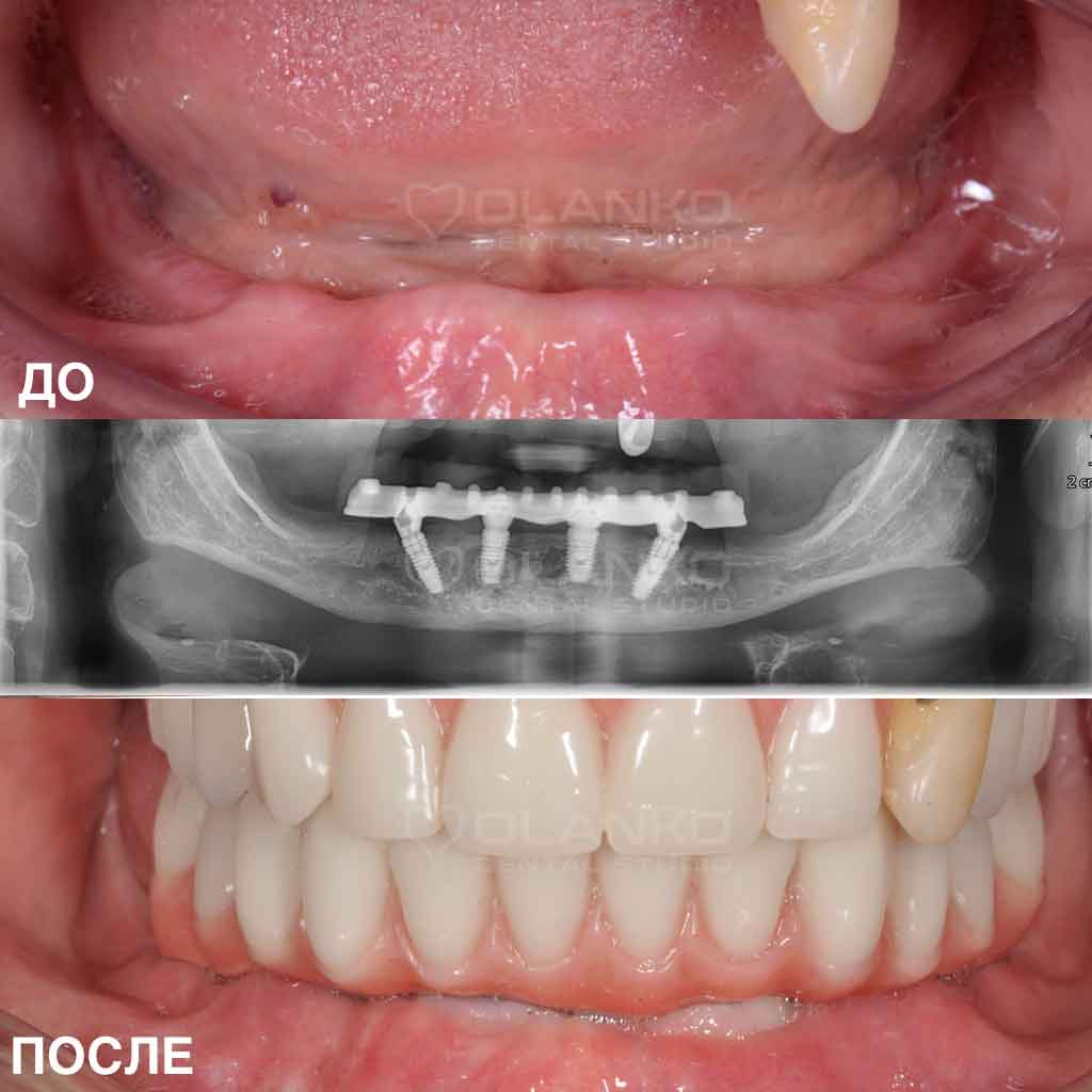 Імплантація при повній відсутності зубів