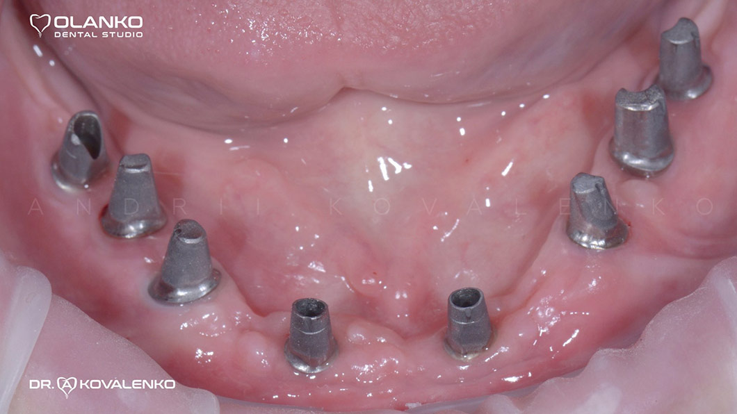 Приклад протезування щелепи з використанням зубних імплантатів