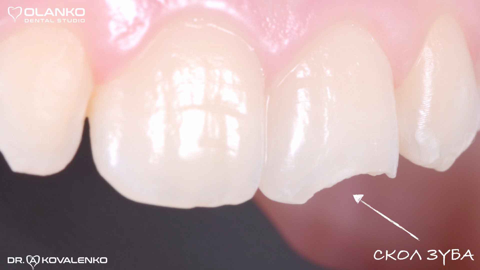 Техніка реставрації зуба фотополімером Оланко