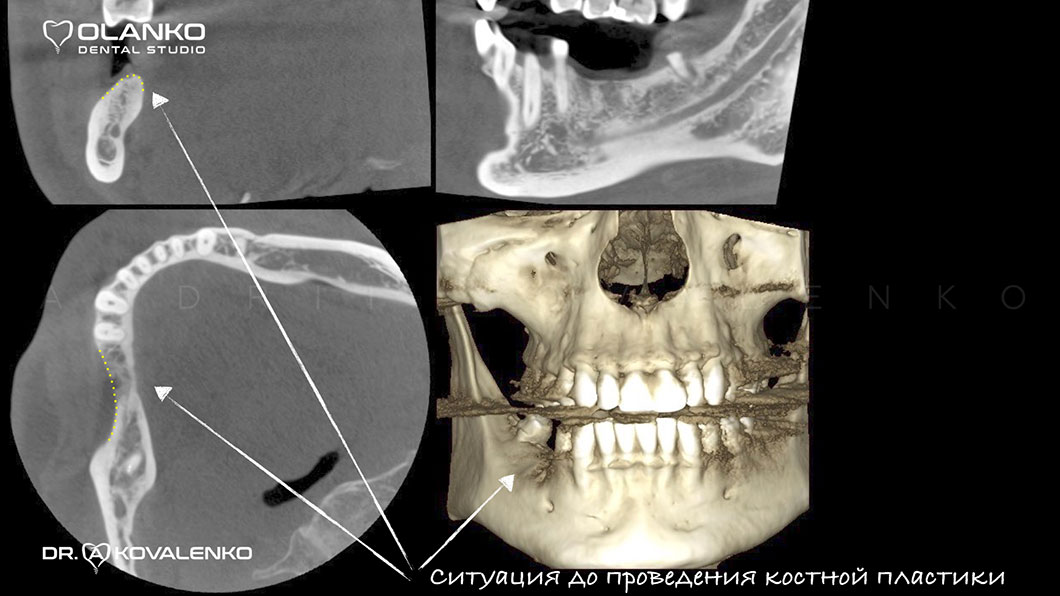 Вигляд  щелепної кістки на 3D знімку до операції нарощування кістки Оланко Бровари Київ