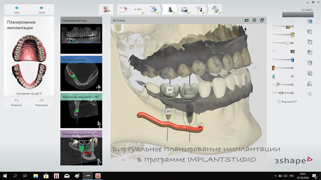 Вигляд  щелепної кістки на 3D знімку Оланко Бровари Київ