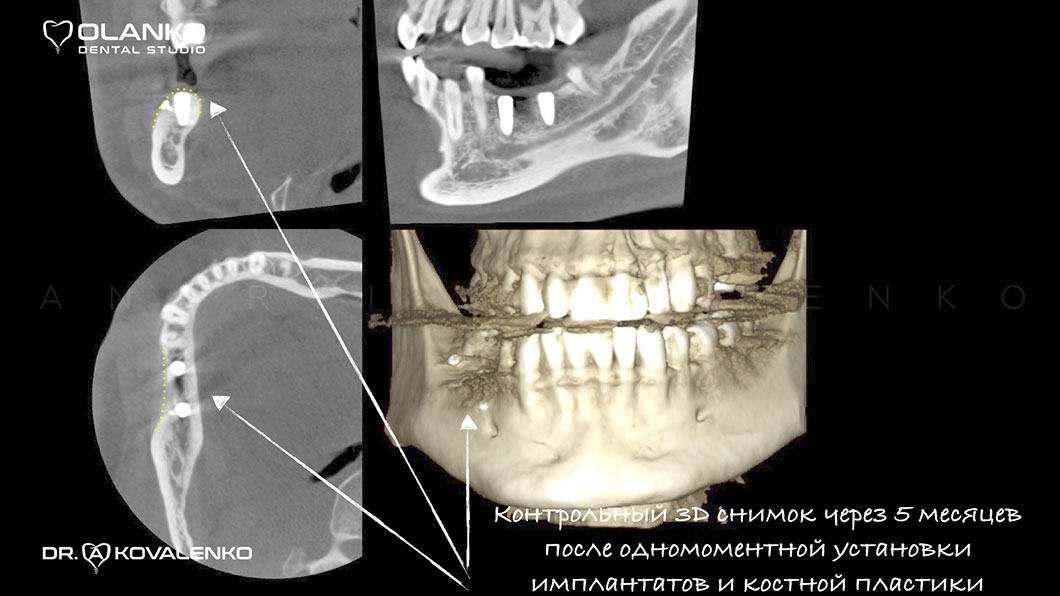 Вигляд кістки після кісткової пластики та встановлення зубних імплантатів Оланко Бровари Київ