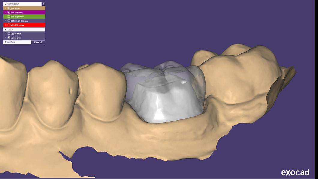 Цифрова стоматологія методом CAD/CAM Бровари Київ Оланко