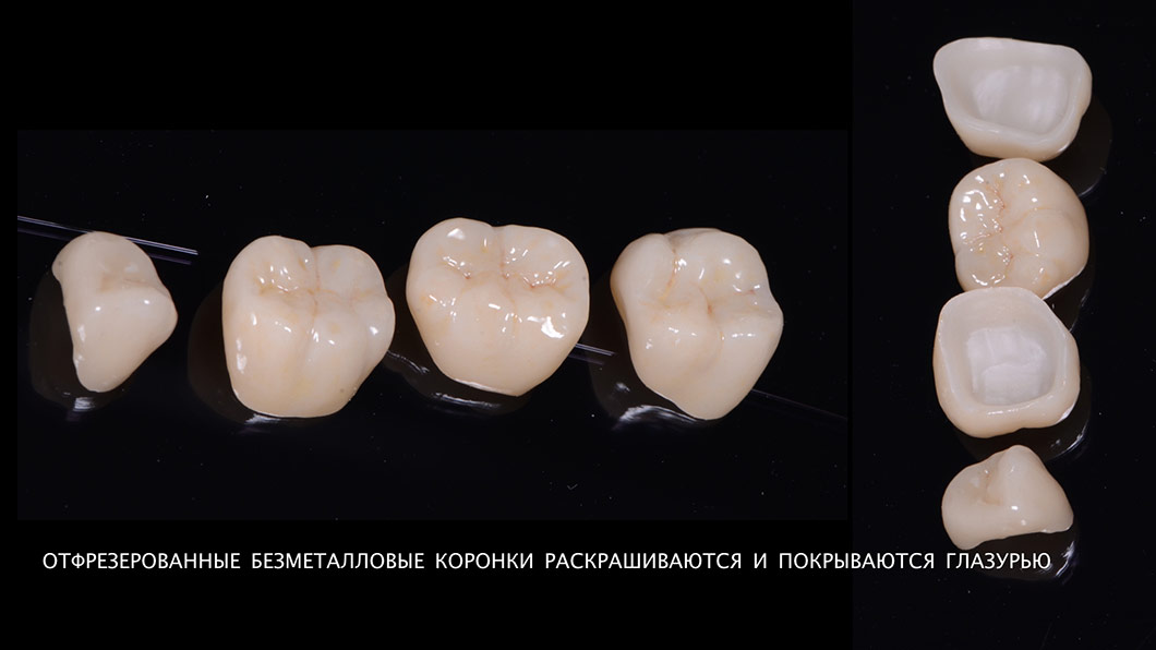 Цифрова стоматологія методом CAD/CAM Цифрові коронки Оланко Бровари Київ