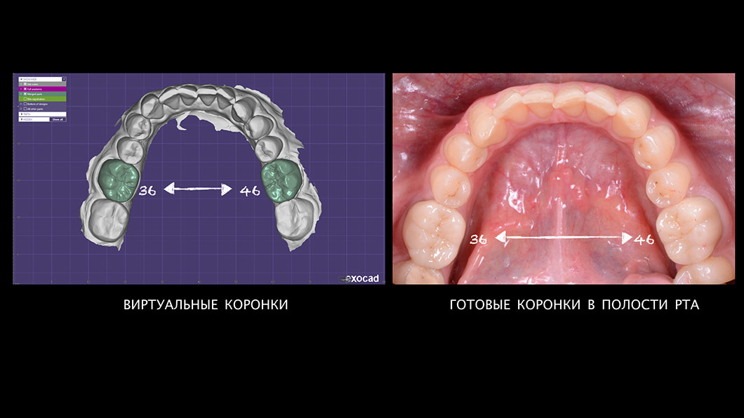 Цифрова стоматологія методом CAD/CAM щелепа зуби Оланко
