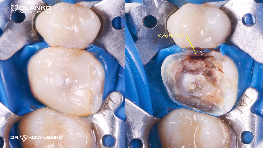 Накладення на зуб спеціальної латексної хустини - кофердаму, для ізоляції зуба від попадання бактерій