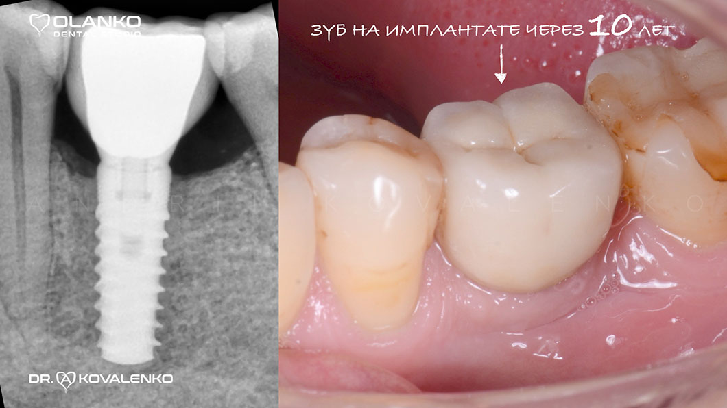 Зубний імплант через 10 років фото | Імплантація зубів Бровари Olanko Київ