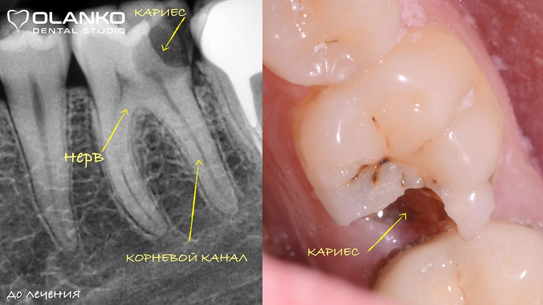 Основні показання до лікування кореневих каналів зубів Київ Бровари