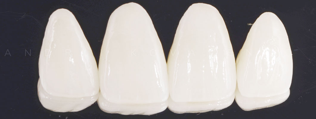 Керамічні коронки на зуби ціна Оланко Бровари