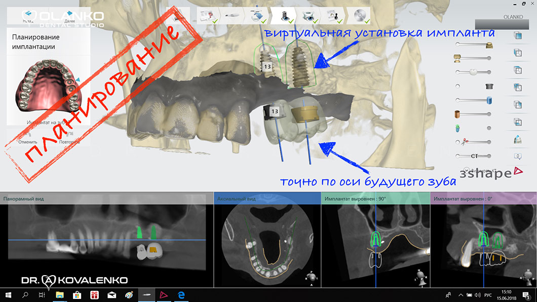Навігаційна імплантація, встановлення зубних імплантів по шаблону, Оланко Бровари Київ