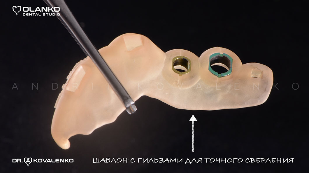 Навігаційна імплантація - встановлення зубних імплантів по шаблону фото 3 Оланко Бровари Київ