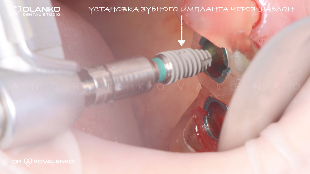 Навігаційна імплантація - встановлення зубних імплантів по шаблону фото 4 Оланко Бровари Київ