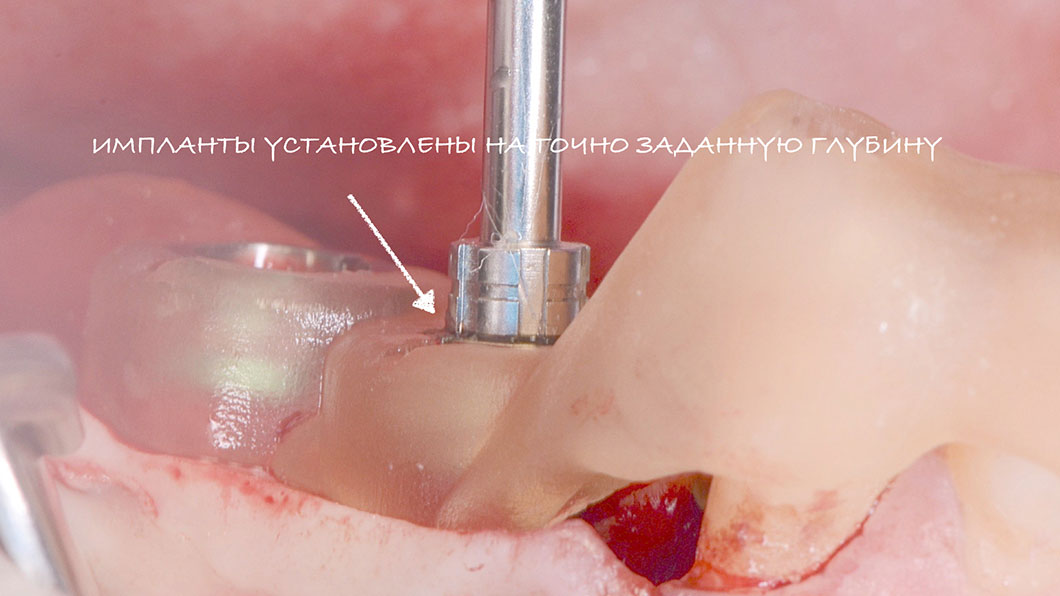 Навігаційна імплантація - встановлення зубних імплантів по шаблону фото 5 Оланко Бровари Київ