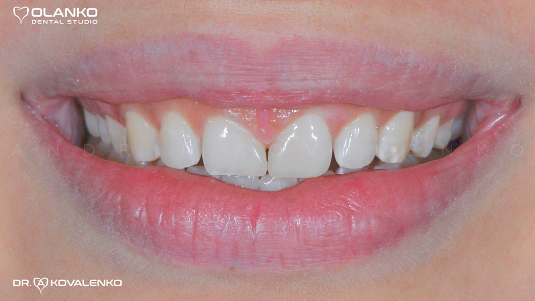 Фото після приклад художньої реставрації передних зубів фотополімером після травми, скола