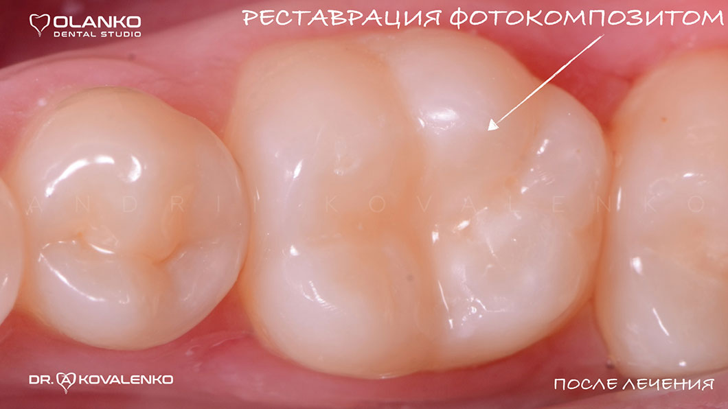 Фото зуба після лікування карієсу. Зуб відновлений фотокомпозитом