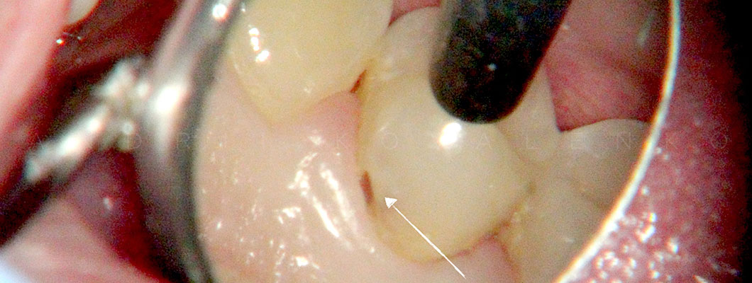 Фото карієса зуба виконане в мікроскоп Оланко