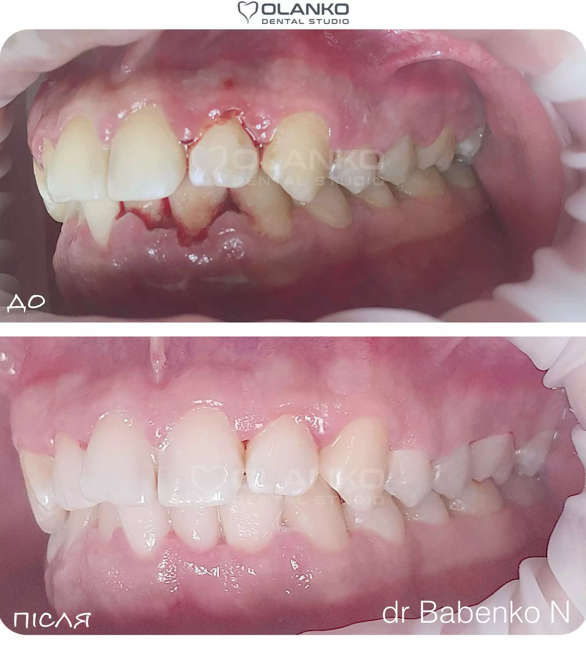 Лечение дёсен пародонтита и пародонтоза аппаратом Вектор Бровары Оланко