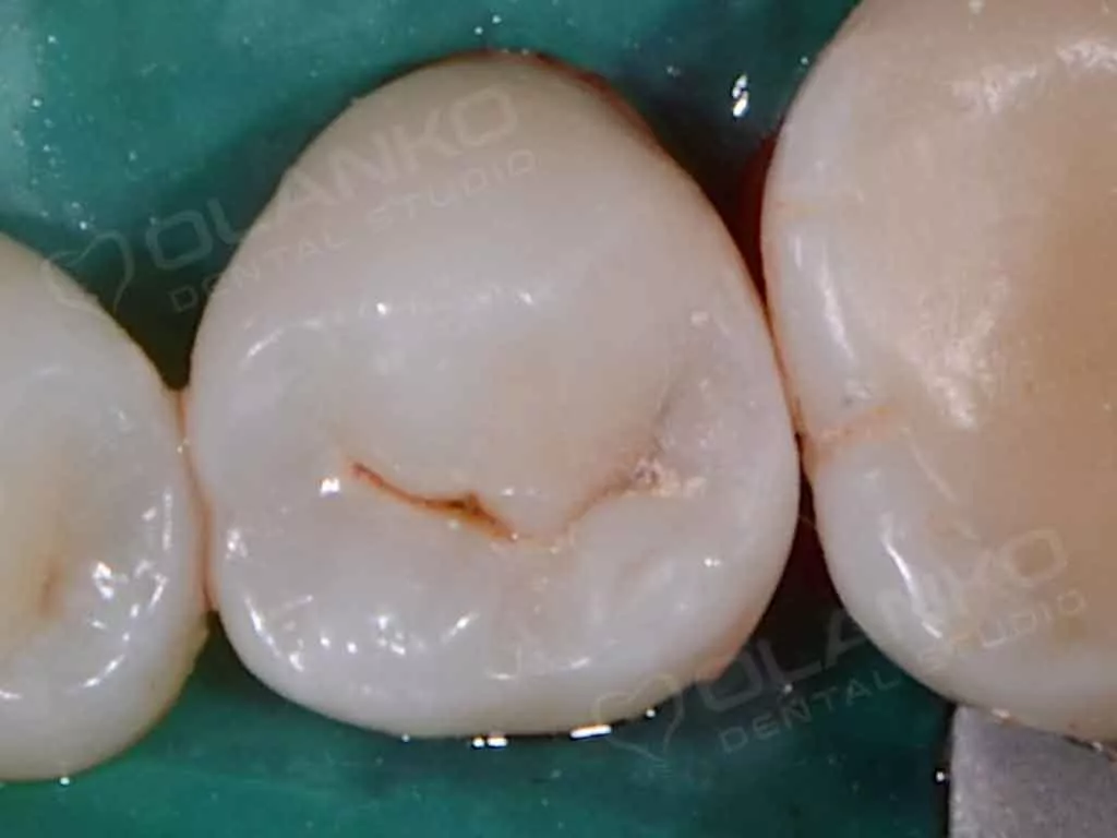 Клинический случай 1 реставрация