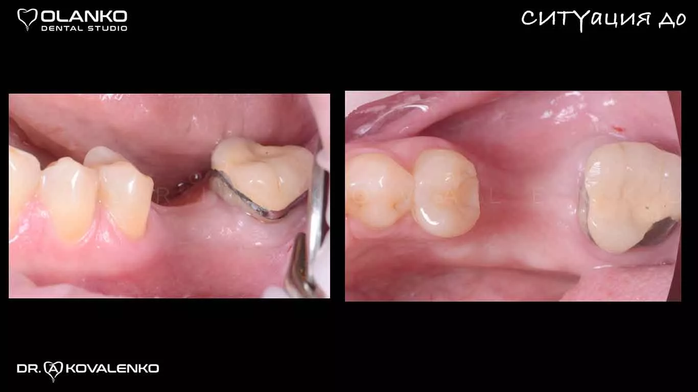 Фото во время установки импланта Straumann&nbsp;через шаблон Оланко Бровары Киев