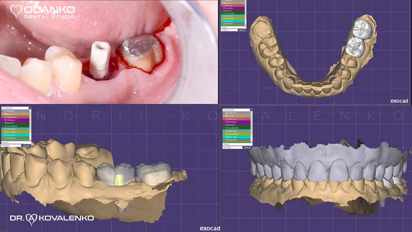Удобное расположение клиники Olanko dental studio (Оланко) в центре&nbsp;г. Бровары, бул.&nbsp;Независимости, 17 (время в пути из Киева 20-40&nbsp;минут).