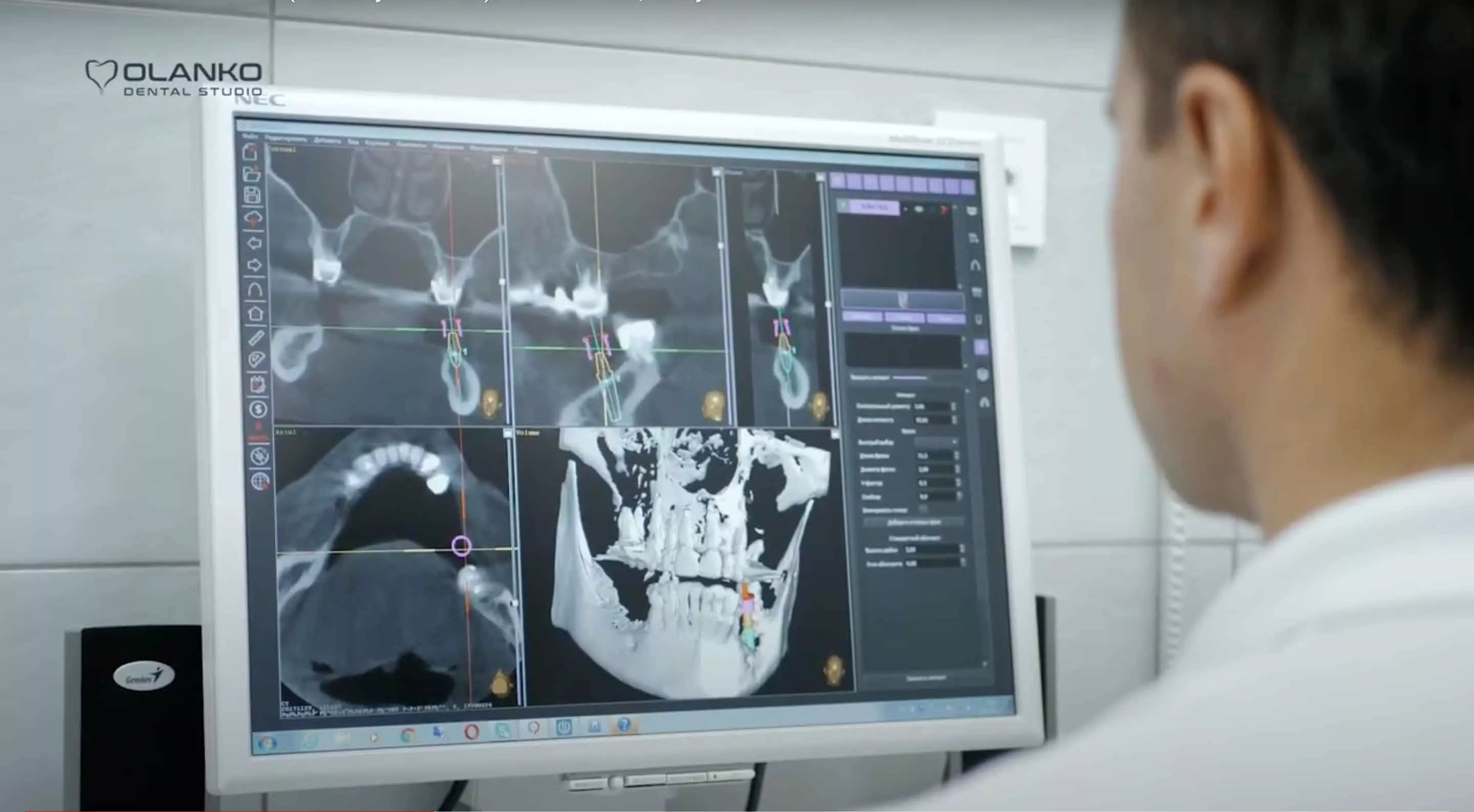 Имплантация зубов