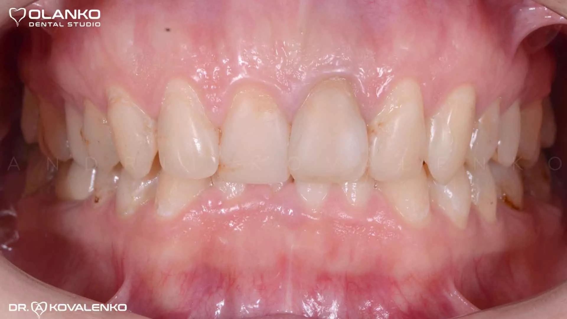 Клинический случай 3 Керамические виниры(коронки)