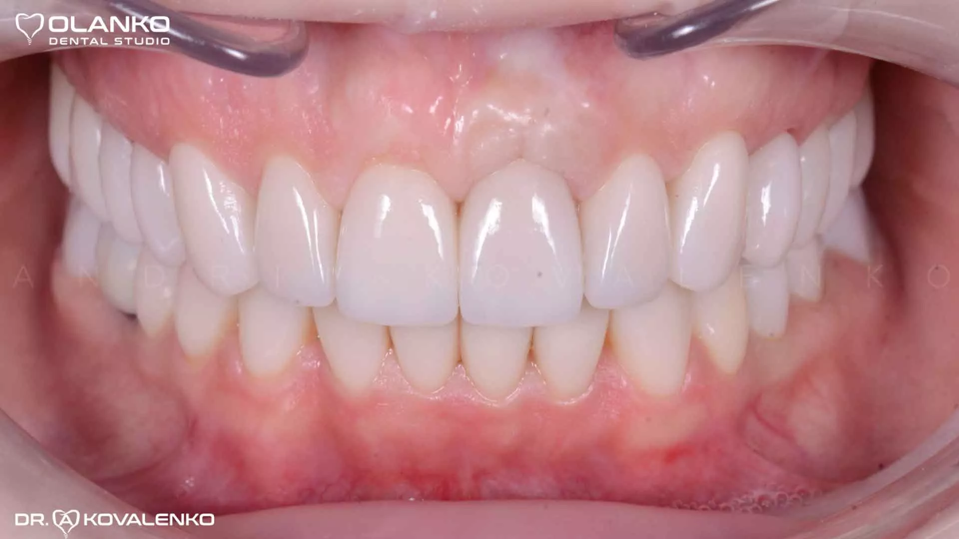 Клинический случай 3 Керамические виниры(коронки)