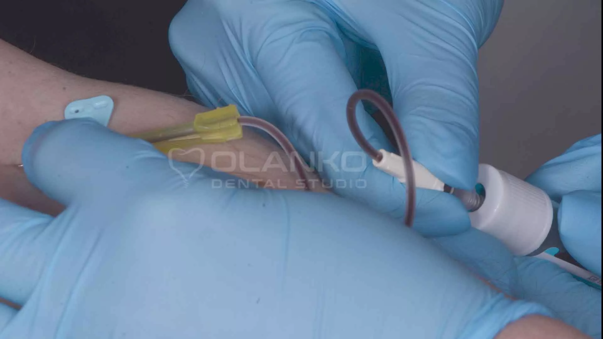 Плазмолифтинг, инъекции для укрепления дёсен, Бровары Оланко Киев