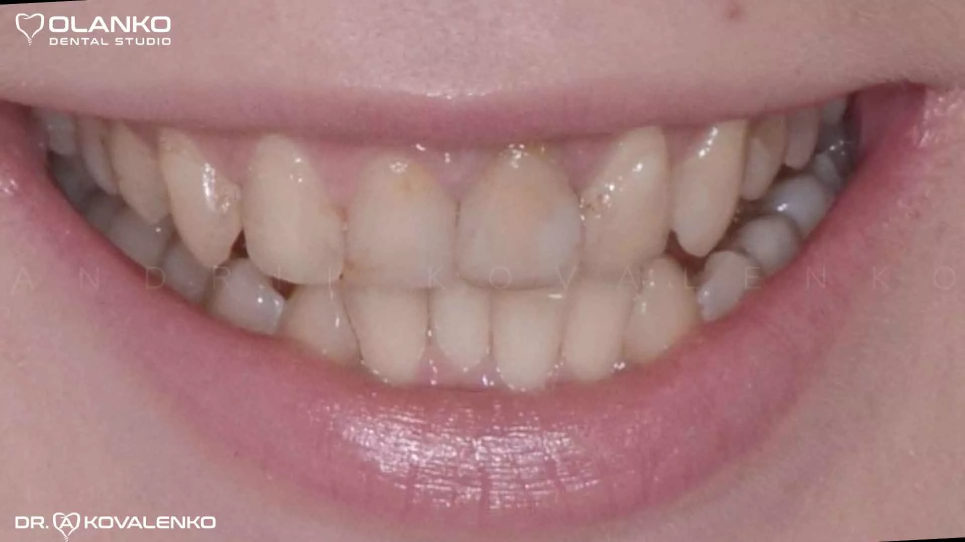 Клинический случай 3 Керамические виниры(коронки)