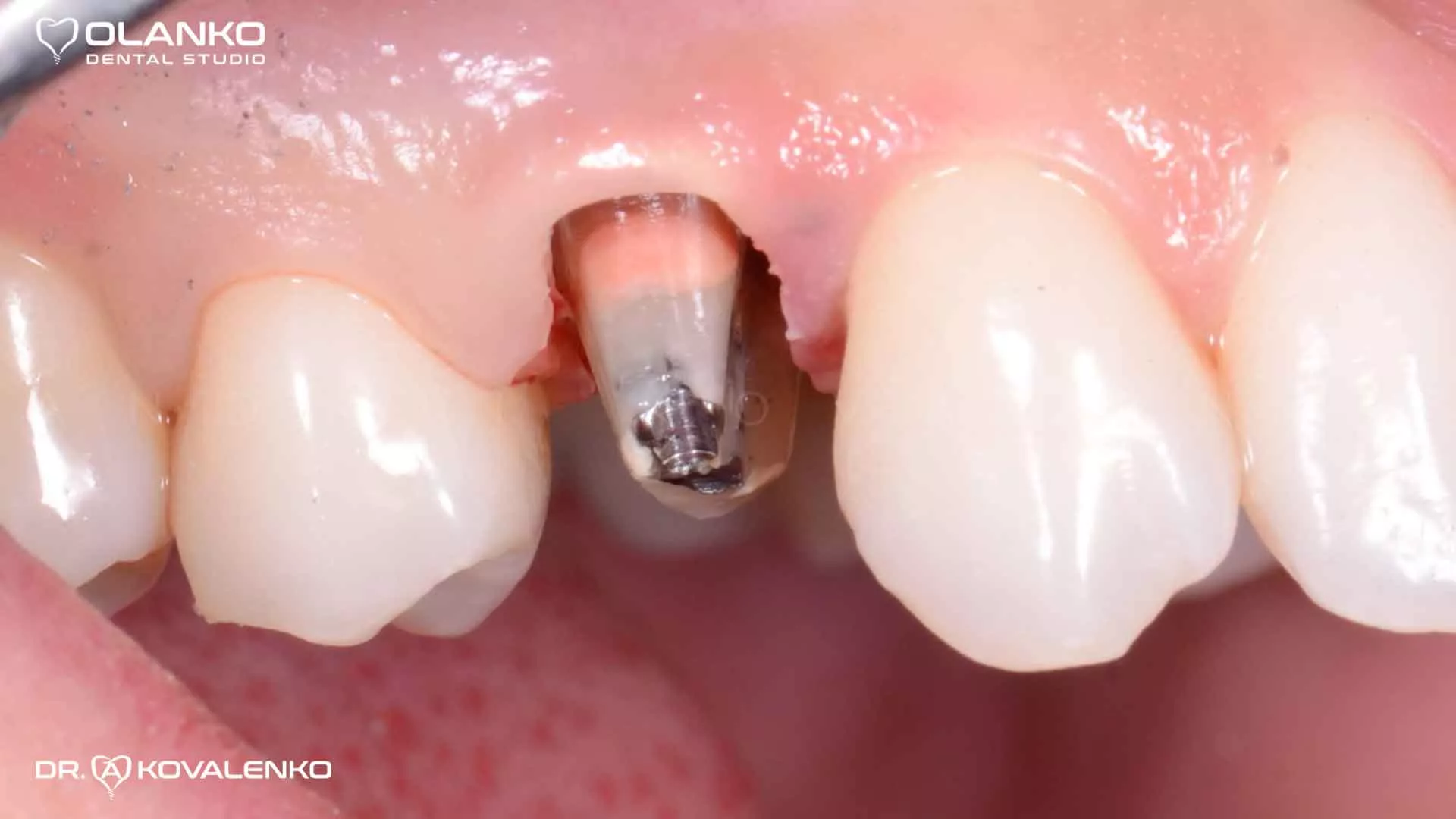 Клинический случай 4 Керамические виниры(коронки)