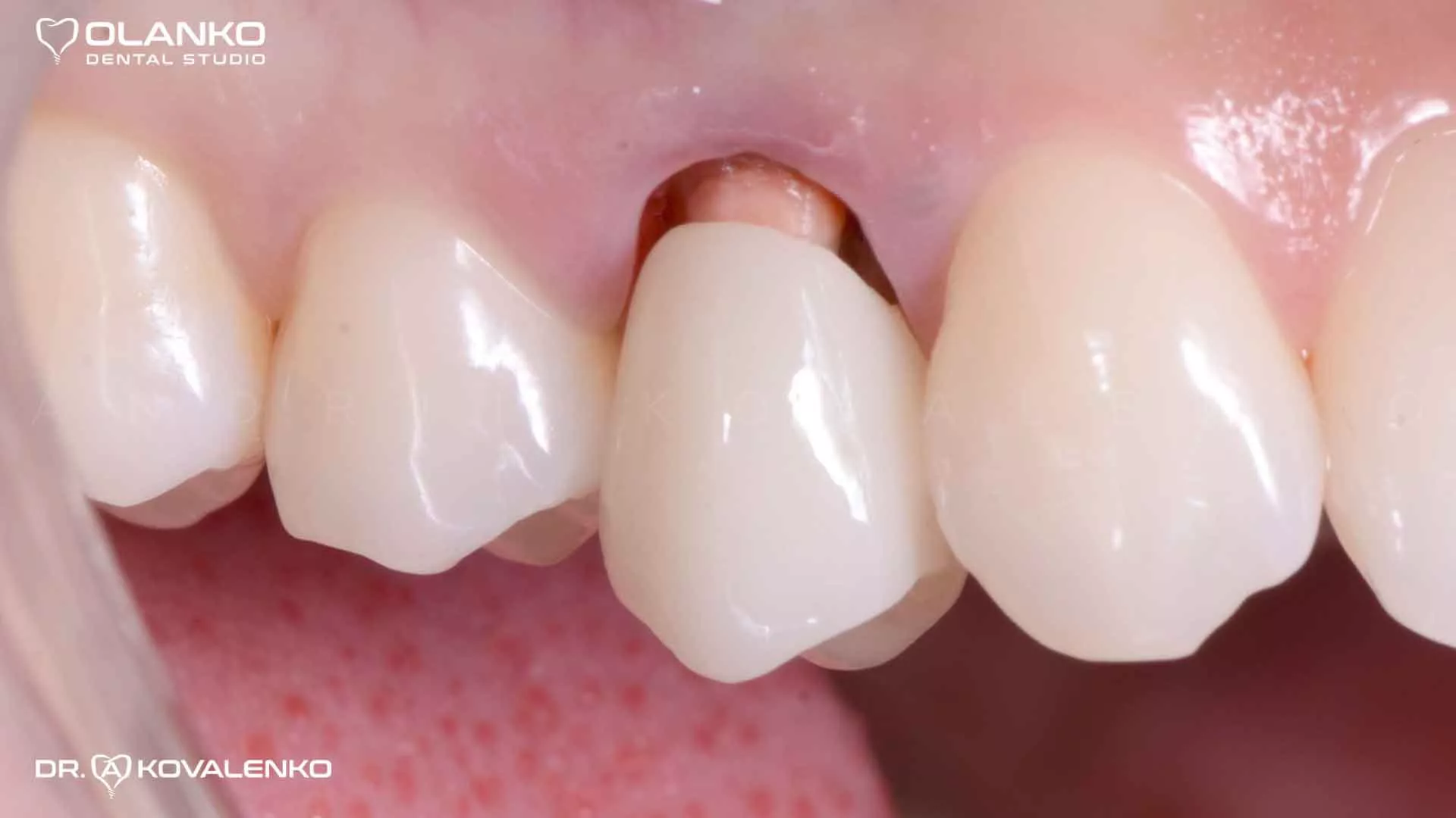 Клинический случай 4 Керамические виниры(коронки)