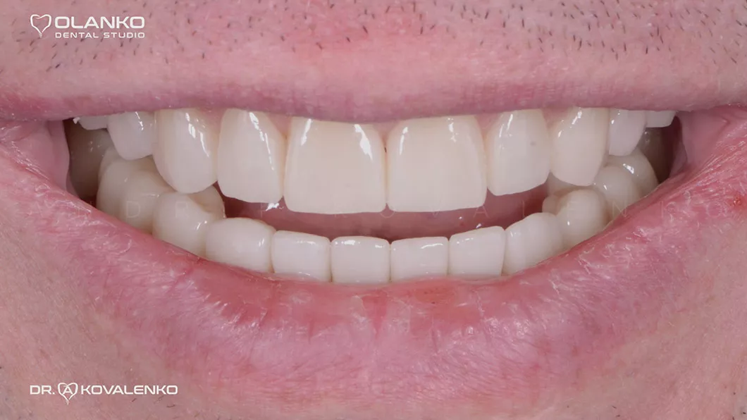 Клинический случай 2 протезирование