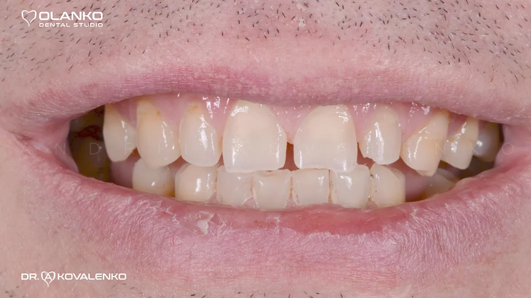 Клинический случай 2 протезирование