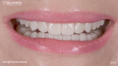 Функционально-эстетическое протезирование зубов