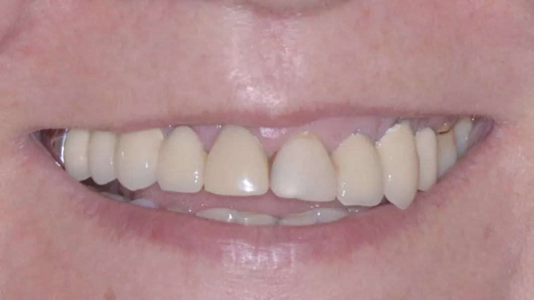 Клинический случай 3 имплантация зубов