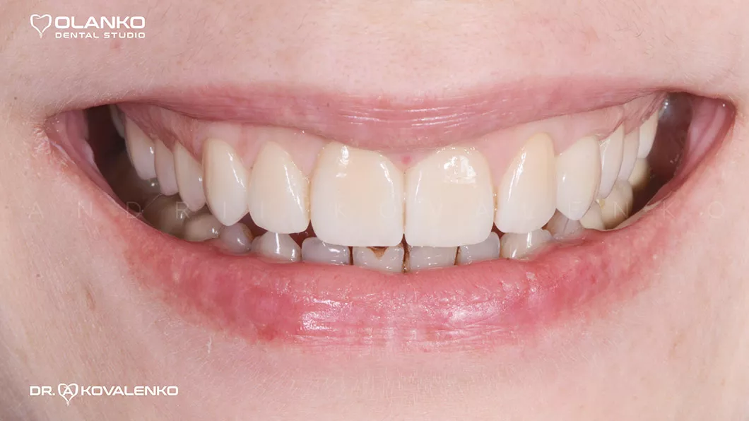 Клинический случай 3 протезирование