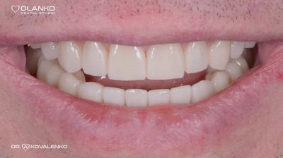 Функционально-эстетическое протезирование зубов