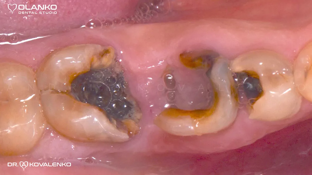 Клинический случай 4 имплантация зубов