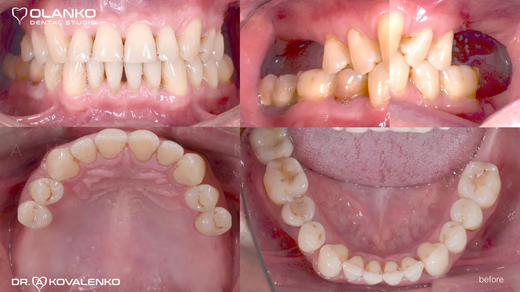 Клинический случай 2 имплантация зубов