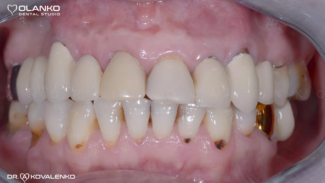 Клинический случай 3 имплантация зубов