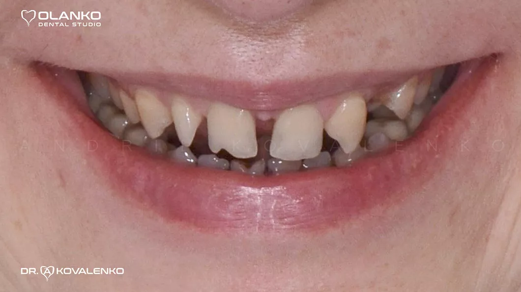 Клинический случай 3 протезирование