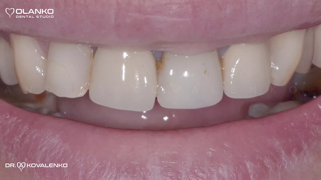 Клинический случай 1 Керамические виниры(коронки)
