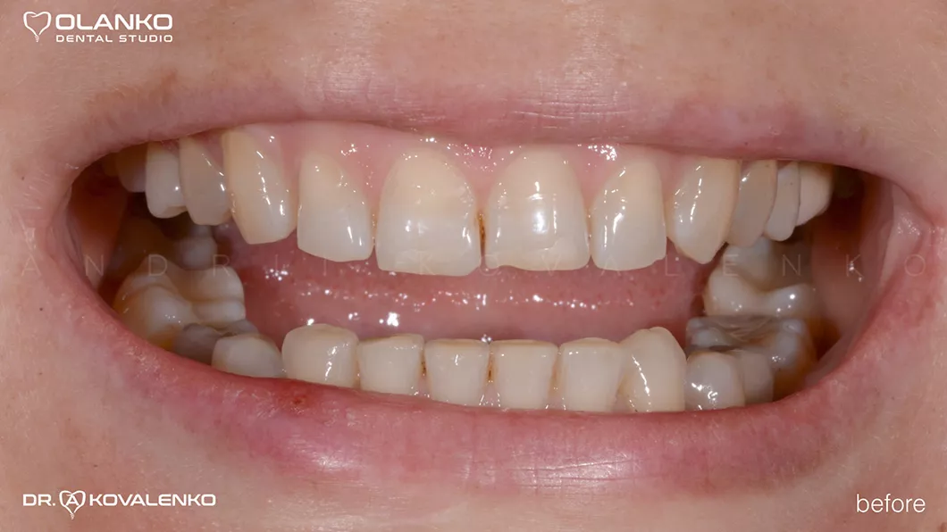 Клинический случай 1 протезирование