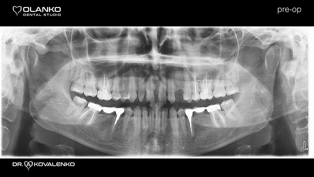 Клинический случай 3 протезирование